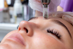 microneedling